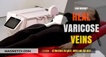Magnetic Therapy for Varicose Veins: Myth or Effective Healing Solution?