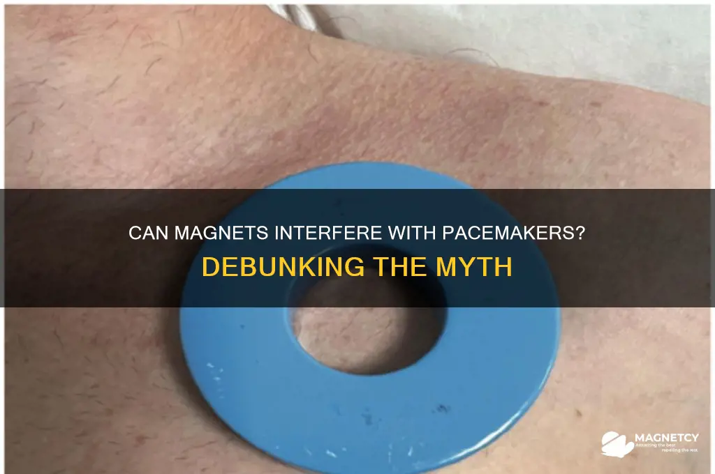 can magnet turn off pacemaker