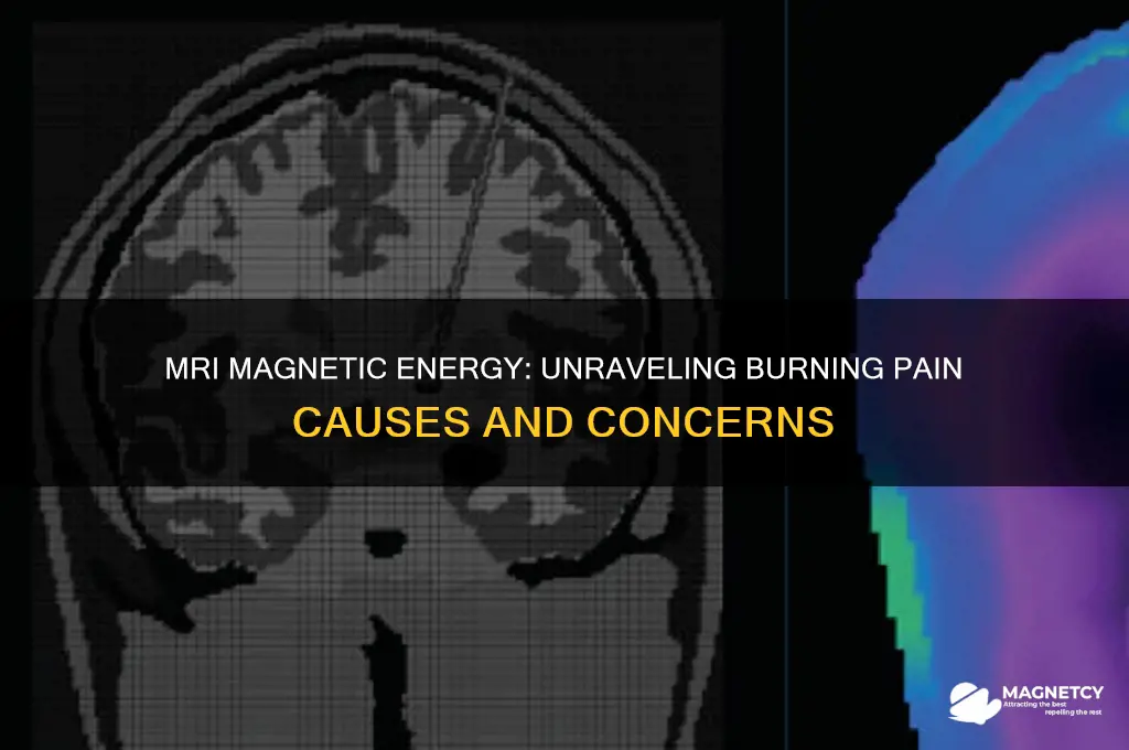 can magnetic energy cause burning pain during an mri