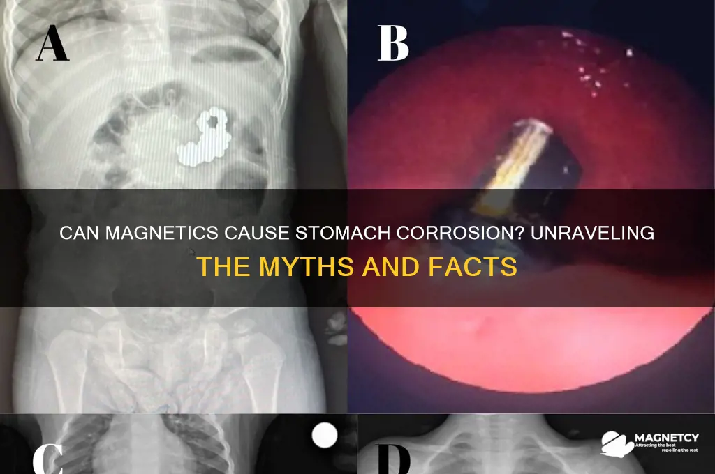 can magnetics corrode your stomache