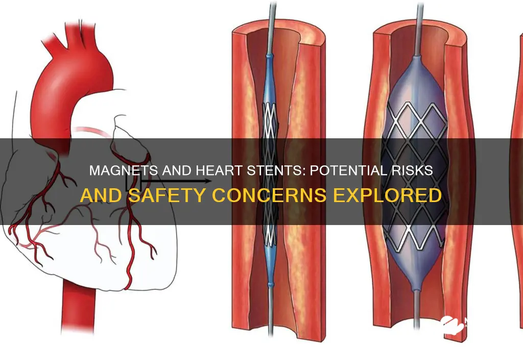 can magnets affect heart stents