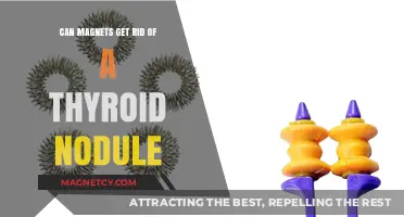 Magnetic Therapy for Thyroid Nodules: Fact or Fiction?