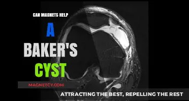Magnetic Therapy for Baker's Cyst: Effective Relief or Myth?