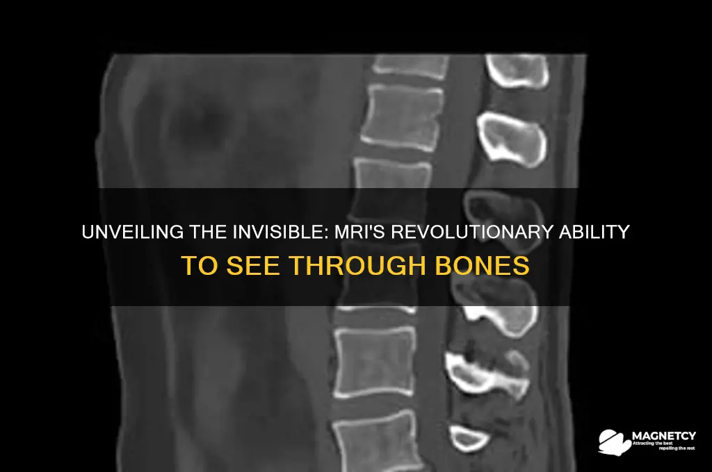can see through bones with magnetic resonance imaging