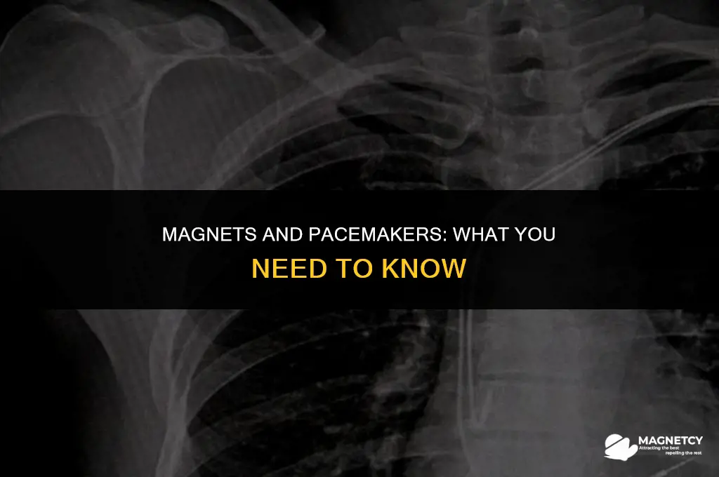 can you have magnets around a pacemaker