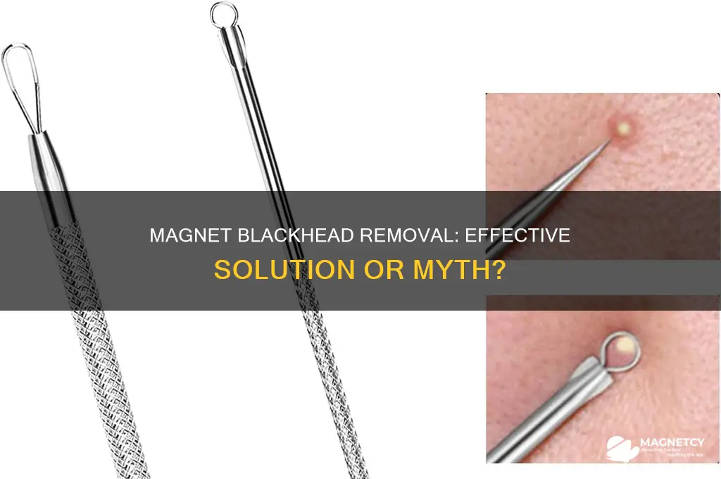 can you use a magnet to get rid of blackheads