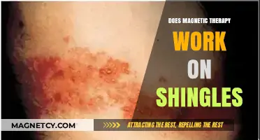 Exploring the Efficacy of Magnetic Therapy for Shingles Relief