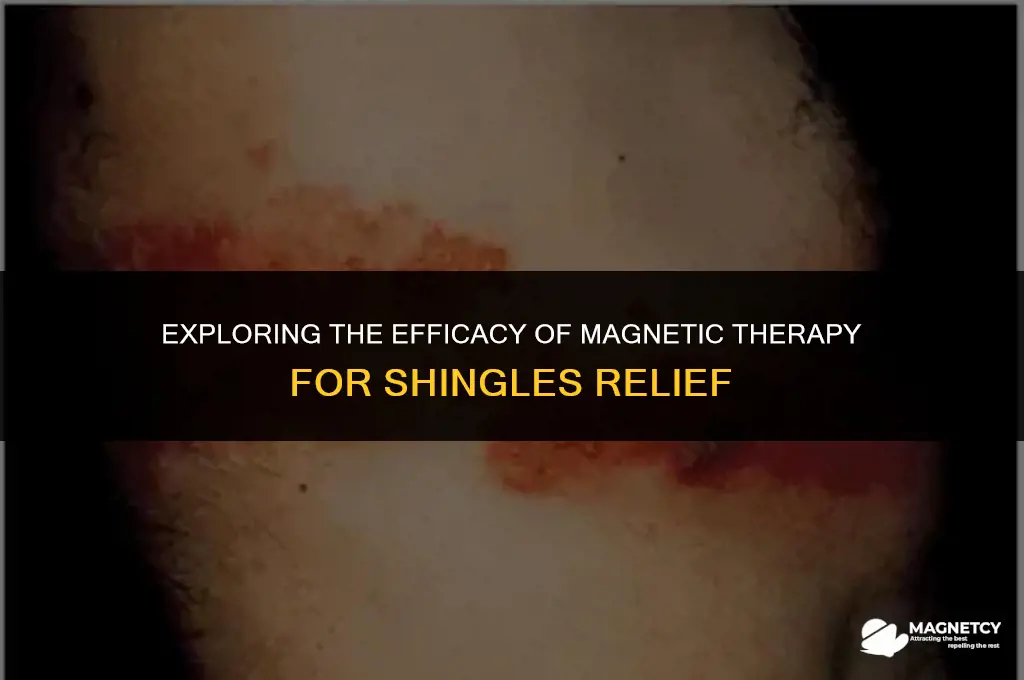 does magnetic therapy work on shingles