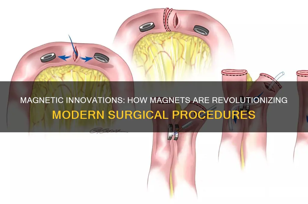when are magnets used in surgery