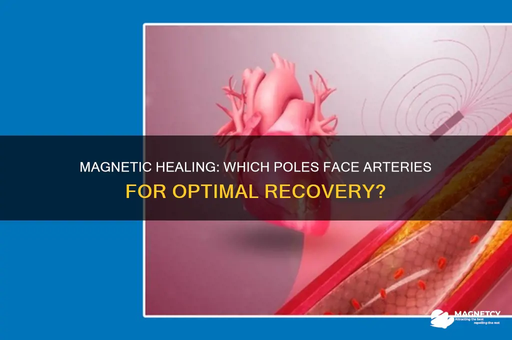 which magnetic poles are used facing arteries for healing